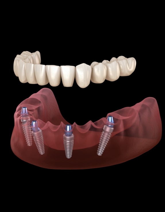Illustrated denture being placed over four dental implants