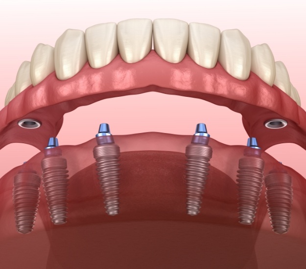 Illustrated implant denture attached to six dental implants