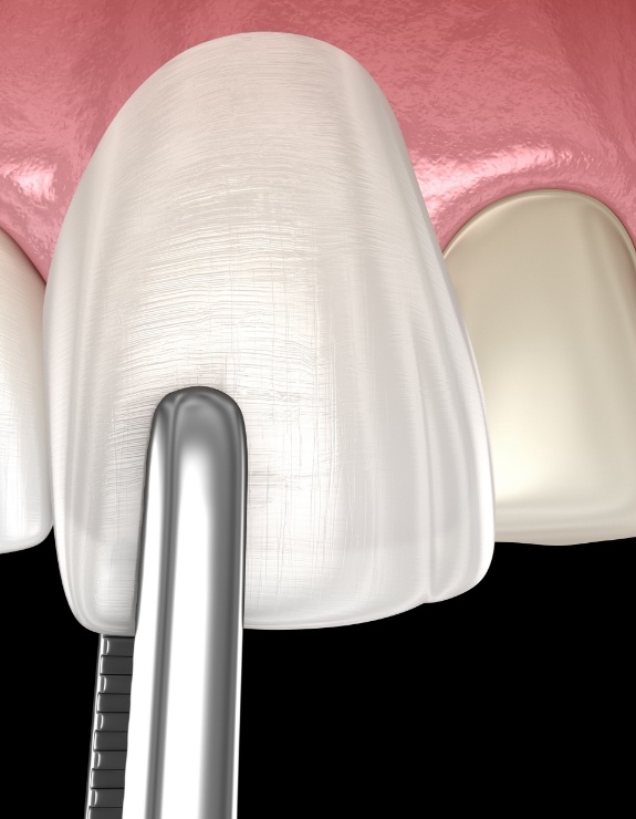 Illustrated veneer being placed over front of tooth