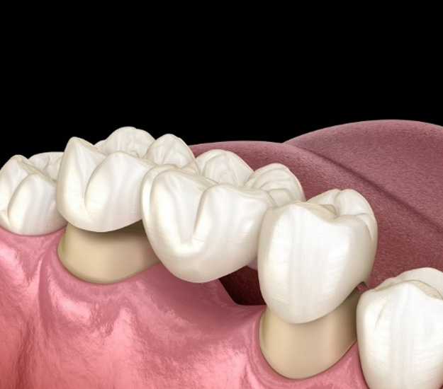 Traditional dental bridge replacing a missing tooth