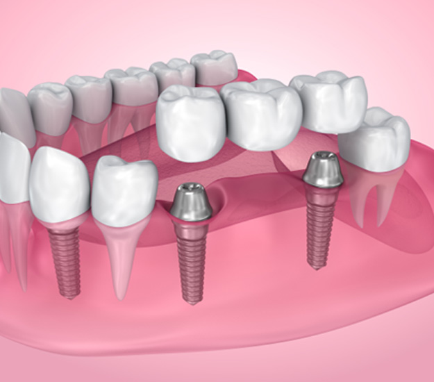 Dental bridge secured onto two dental implants