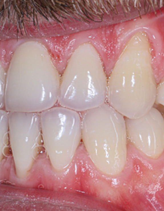 Close up of a mouth with slightly receding and swollen gums