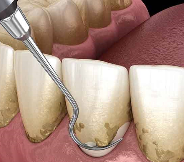Illustration of a dental scaler clearing tartar from the teeth and gums