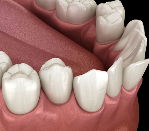 Illustration of crowded teeth
