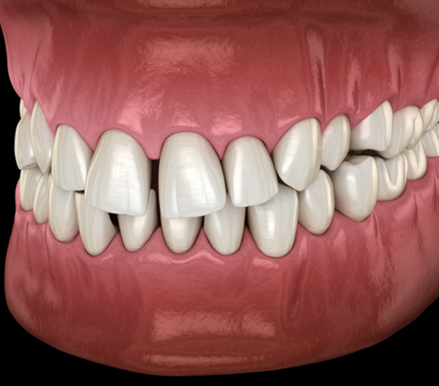 Illustration of gapped teeth