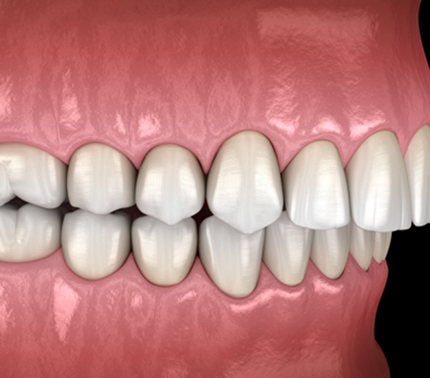 Illustration of an overbite