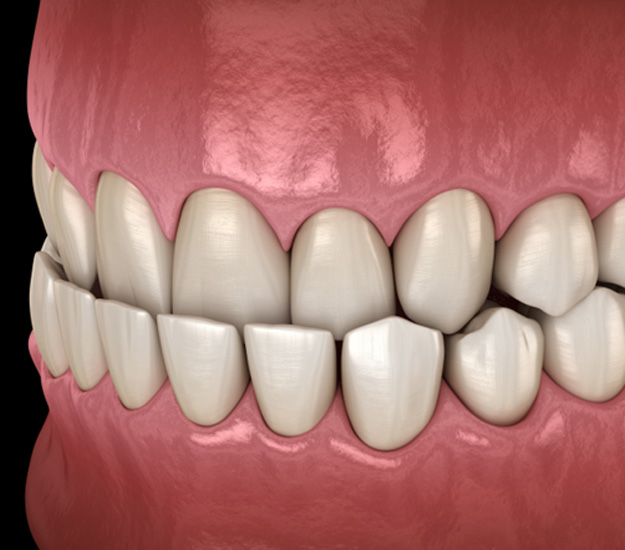 Illustration of an underbite