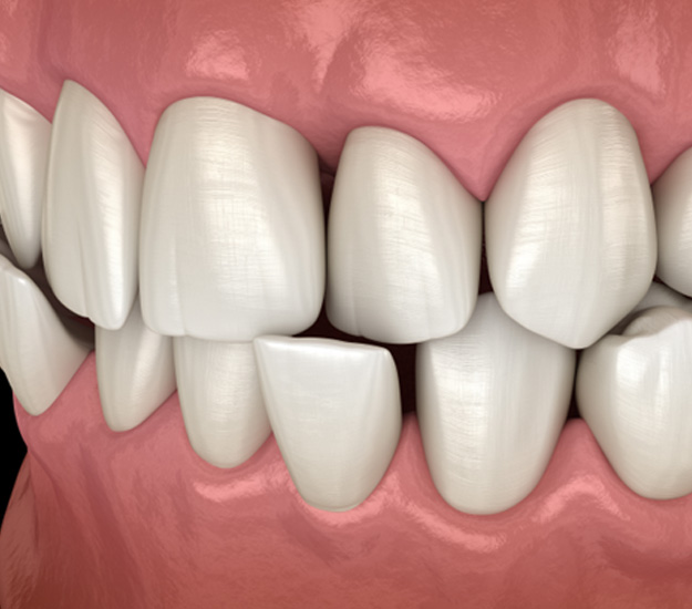 Illustration of a crossbite