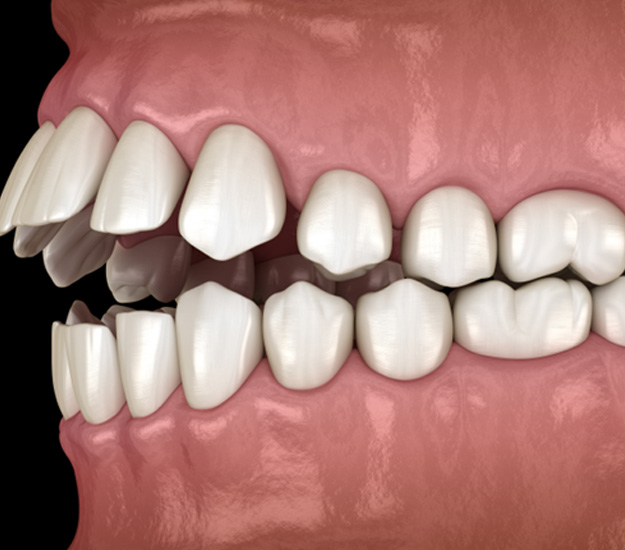 Illustration of an open bite