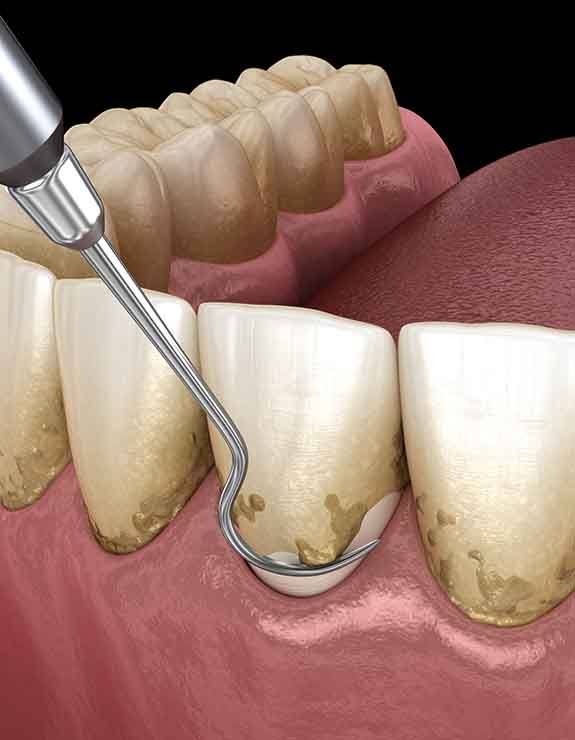 Illustration of scaling and root planing for gum disease treatment in Arlington Heights