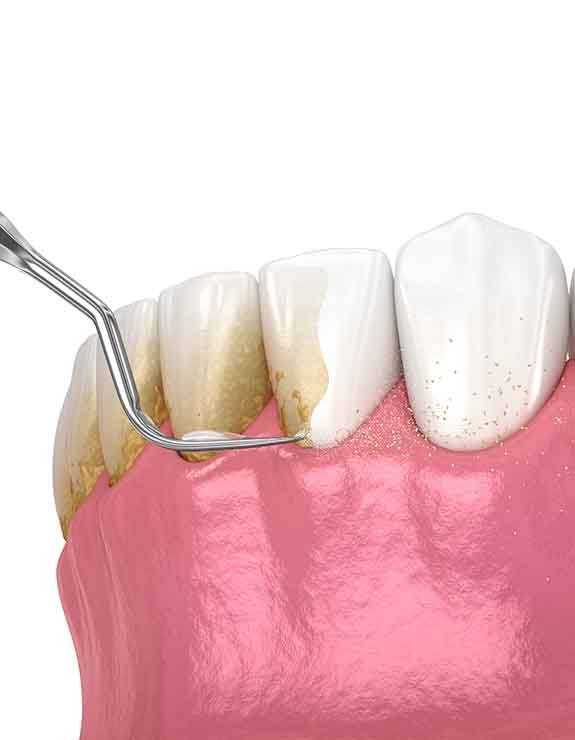 Illustration of scaling and root planing for lower arch of teeth