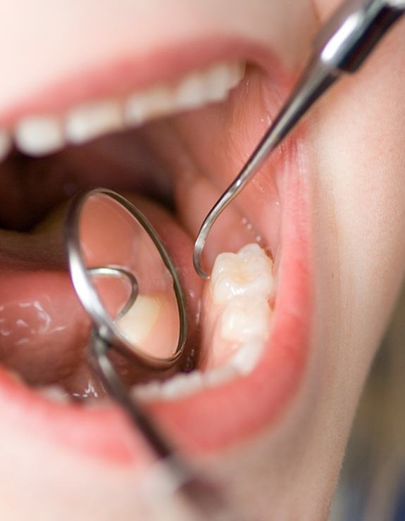 Up-close view of child’s mouth and molars