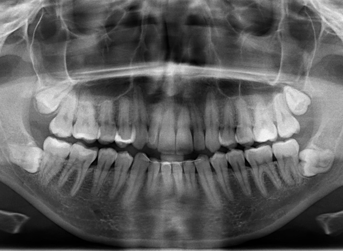 X-ray with wisdom teeth growing in