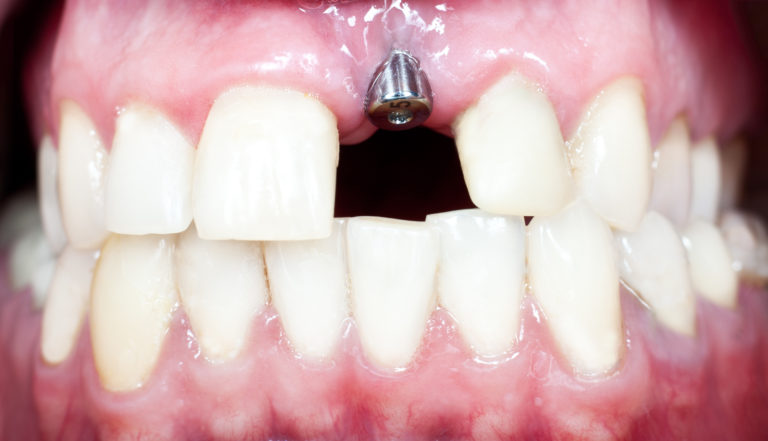 Dentist in Arlington Heights - Handling A Failing Dental Implant