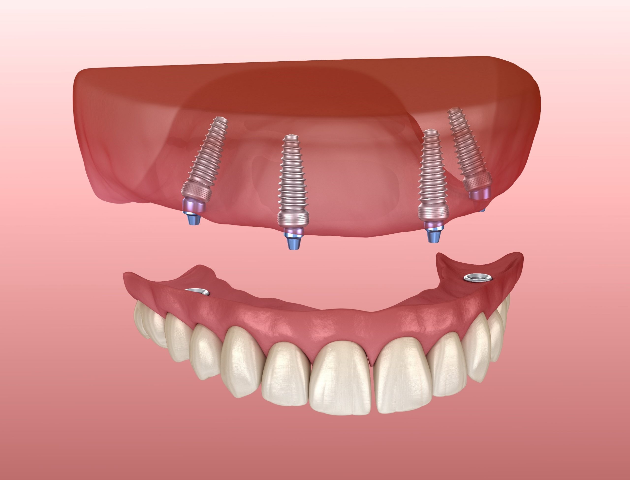 implant-retained-denture-2-costello-dental-blog