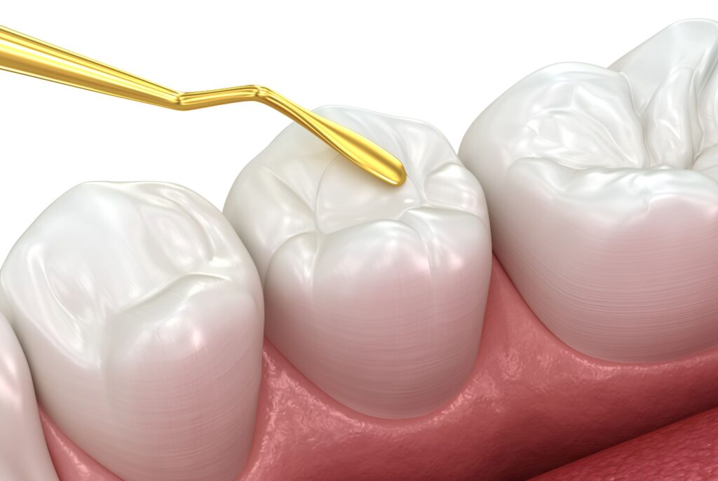 Rendering of clear sealant being applied to tooth